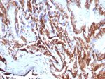 KRT7 Antibody rKRT7/8763 Immunohistochemistry Analysis. IHC staining of FFPE human prostate carcinoma tissue with recombinant KRT7 antibody (clone rKRT7/8763). HIER: boil tissue sections in pH 9 10mM Tris with 1mM EDTA for 20 min and allow to cool before testing.