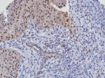 CDK4 Antibody Bladder Cancer IHC. Immunohistochemical analysis of Cyclin-dependent kinase 4 (CDK4) in formalin-fixed, paraffin-embedded human bladder cancer tissue using CDK4 antibody clone CDK4/8351R. Predominant nuclear staining is observed in tumor epithelial cells, consistent with the role of CDK4 in regulating G1 to S phase cell cycle progression, with additional weaker cytoplasmic signal in some cells. The staining pattern supports active cell cycle signaling in proliferating tumor regions. Required HIER: boil tissue sections in pH 9 10mM Tris with 1mM EDTA for 20 min and allow to cool before testing.