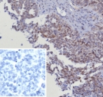 CDK4 Antibody Ovarian Cancer IHC. Immunohistochemical analysis of Cyclin-dependent kinase 4 (CDK4) in formalin-fixed, paraffin-embedded human serous ovarian cancer tissue using CDK4 antibody clone CDK4/8351R. Predominant nuclear staining is observed in tumor epithelial cells, with additional weaker cytoplasmic signal, consistent with the role of CDK4 in regulating G1 to S phase cell cycle progression. The staining highlights proliferative tumor regions and supports active cell cycle signaling. Inset: PBS used in place of primary antibody serves as a negative control for secondary antibody binding. Required HIER: boil tissue sections in pH 9 10mM Tris with 1mM EDTA for 20 min and allow to cool before testing.