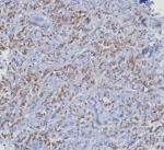 CDK4 Antibody Breast Cancer IHC. Immunohistochemical analysis of Cyclin-dependent kinase 4 (CDK4) in formalin-fixed, paraffin-embedded human mammary cancer tissue using CDK4 antibody clone CDK4/8351R. Predominant nuclear staining is observed in tumor epithelial cells with variable cytoplasmic signal, consistent with the role of CDK4 in regulating G1 to S phase cell cycle progression. The staining pattern highlights proliferative tumor regions and supports active cell cycle signaling in breast carcinoma. Required HIER: boil tissue sections in pH 9 10mM Tris with 1mM EDTA for 20 min and allow to cool before testing.