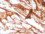 Decorin Antibody Rabbit Monoclonal Prostate IHC. Immunohistochemistry of Decorin antibody in human prostate carcinoma tissue. Formalin-fixed, paraffin-embedded human prostate carcinoma was stained using rabbit monoclonal Decorin antibody (clone DCN/8760R). Heat induced epitope retrieval was performed by boiling tissue sections in 10mM Tris with 1mM EDTA, pH 9, for 20 min followed by cooling prior to staining. HRP-DAB brown chromogenic signal highlights extracellular stromal connective tissue and desmoplastic matrix surrounding malignant glands, consistent with Decorin localization within collagen-rich tumor stroma.