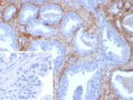POSTN Antibody Human Prostate Tissue IHC. Immunohistochemistry staining of FFPE human prostate tissue with recombinant POSTN antibody (clone rPOSTN/8522). Inset: PBS used in place of primary Ab (secondary Ab negative control). HIER: boil tissue sections in pH 9 10mM Tris with 1mM EDTA for 20 min and allow to cool before testing.