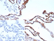 POSTN Antibody Human Lung Tissue IHC. Immunohistochemistry staining of FFPE human lung tissue with recombinant POSTN antibody (clone rPOSTN/8522). Inset: PBS used in place of primary Ab (secondary Ab negative control). HIER: boil tissue sections in pH 9 10mM Tris with 1mM EDTA for 20 min and allow to cool before testing.