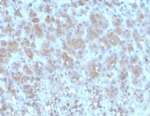 Immunohistochemistry of Periostin antibody in human adrenal gland tissue. Formalin-fixed, paraffin-embedded human adrenal gland was stained with microarray validated Periostin / POSTN antibody (clone POSTN/3502). Brown chromogenic signal is observed predominantly within stromal and extracellular matrix compartments between adrenal cortical cell nests, consistent with the secreted and matrix-associated localization of Periostin, while most adrenal parenchymal nuclei remain negative.