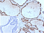Immunohistochemistry of TTF-1 Antibody / Thyroid Epithelial Differentiation Marker Antibody in human thyroid tissue. FFPE human thyroid tissue stained using TTF-1 Antibody / Thyroid Epithelial Differentiation Marker Antibody. The mouse monoclonal clone TTF1/8427 antibody demonstrates strong nuclear staining in thyroid follicular epithelial cells lining thyroid follicles, highlighting differentiated thyroid epithelial cells. Nuclear immunoreactivity for Thyroid transcription factor 1 (NKX2-1) marks thyroid follicular epithelial lineage and reflects the established role of TTF-1 as a thyroid epithelial differentiation marker used in immunohistochemistry to identify differentiated thyroid epithelium and evaluate epithelial lineage within thyroid tissue. Inset: PBS used in place of primary antibody (secondary antibody negative control). HIER: boil tissue sections in pH9 10mM Tris with 1mM EDTA for 20 min and allow to cool before testing.