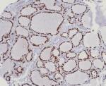 NKX2.1 Antibody for IHC / NKX2.1 Immunohistochemistry Antibody (clone TTF1/8123R) immunohistochemistry analysis of human lung adenocarcinoma tissue. Formalin-fixed, paraffin-embedded human lung adenocarcinoma stained with recombinant rabbit monoclonal clone TTF1/8123R antibody shows strong nuclear staining in malignant epithelial cells, consistent with the nuclear localization of Thyroid transcription factor 1 (NKX2-1). The nuclear immunoreactivity observed in tumor epithelial cells highlights NKX2-1 expression in lung adenocarcinoma detected by immunohistochemistry in FFPE tissue sections. HIER: boil tissue sections in pH 9 10mM Tris with 1mM EDTA for 20 min and allow to cool before testing.