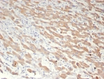 GFRP Antibody Liver Cancer IHC. Immunohistochemistry analysis of FFPE human hepatocellular carcinoma tissue stained with GFRP antibody clone GCHFR/7731 demonstrates diffuse cytoplasmic HRP-DAB brown staining throughout tumor-associated hepatic cellular populations, consistent with expression of GTP cyclohydrolase I feedback regulator / GCHFR in tetrahydrobiopterin metabolism and nitric oxide-associated metabolic signaling pathways. The observed staining profile aligns with the intracellular cofactor regulatory role of GFRP within metabolically active hepatic tissue environments. HIER: boil tissue sections in pH 9 10mM Tris with 1mM EDTA for 20 min and allow to cool before testing.