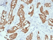 IHC staining of TrkC / NTRK3 antibody (clone NTRK3/7140). FFPE human breast cancer tissue shows HRP-DAB brown membranous and cytoplasmic staining in tumor epithelial cells, consistent with receptor tyrosine kinase localization. Staining of formalin-fixed tissues requires boiling tissue sections in pH 9 10mM Tris with 1mM EDTA for 20 min followed by cooling at RT before testing.