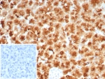 Immunohistochemistry analysis of GP2 antibody in human pancreas. GP2 Antibody Recombinant mouse MAb rGP2/8617 was used for immunohistochemistry on FFPE human pancreas tissue. Strong HRP-DAB brown cytoplasmic and apical staining is observed in pancreatic acinar epithelial cells, consistent with the known localization of Glycoprotein 2 (GP2) to pancreatic zymogen granule membranes in exocrine pancreas. The staining highlights secretory acinar cell clusters, while surrounding stromal regions show minimal signal. Inset: PBS used in place of primary antibody as a secondary antibody negative control. HIER: boil tissue sections in pH 9 10mM Tris with 1mM EDTA for 20 min and allow to cool before testing.