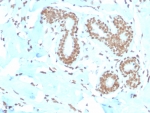 E2F4 Antibody Breast Carcinoma IHC. Immunohistochemistry analysis of FFPE human breast carcinoma tissue stained with E2F4 antibody detecting E2F transcription factor 4, clone E2F4/4224. Tumor epithelial cells show strong nuclear staining, consistent with localization of E2F4 as a transcriptional regulator within the RB pathway controlling cell cycle progression and gene repression. The staining highlights malignant glandular structures, while surrounding stromal regions show comparatively reduced signal. Hematoxylin counterstain highlights nuclei in blue. HIER: boil tissue sections in pH 9 10 mM Tris with 1 mM EDTA for 20 min and allow to cool before testing.