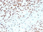TP53 Antibody / Genome Stability Regulator Antibody immunohistochemistry of human bladder tissue. Formalin-fixed, paraffin-embedded human bladder tissue was stained using recombinant mouse monoclonal antibody clone rTP53/3889. Strong HRP-DAB brown nuclear staining is observed in urothelial epithelial cells, consistent with nuclear localization of the TP53 genome stability regulator protein p53. Hematoxylin counterstain provides nuclear contrast. Antigen retrieval was performed by boiling tissue sections in pH 9 10mM Tris with 1mM EDTA for 20 min followed by cooling prior to staining.