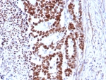 TP53 Antibody / Apoptosis Regulator Antibody immunohistochemistry of human colon carcinoma. Formalin-fixed, paraffin-embedded human colon carcinoma tissue was stained using recombinant mouse monoclonal antibody clone rTP53/8579. Strong HRP-DAB brown nuclear staining is observed in tumor epithelial cells, consistent with nuclear localization of the TP53 apoptosis regulator protein p53. Hematoxylin counterstain provides nuclear contrast. Antigen retrieval was performed by boiling tissue sections in pH 9 10mM Tris with 1mM EDTA for 20 min followed by cooling prior to staining.