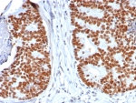 TP53 Antibody / Cell Cycle Checkpoint Protein Antibody immunohistochemistry of human colon carcinoma. Formalin-fixed, paraffin-embedded human colon carcinoma tissue was stained using recombinant mouse monoclonal antibody clone rTP53/8063. Strong HRP-DAB brown nuclear staining is observed in tumor epithelial cells, consistent with nuclear localization of the TP53 cell cycle checkpoint protein p53. Hematoxylin counterstain provides nuclear contrast. Antigen retrieval was performed by boiling tissue sections in pH 9 10mM Tris with 1mM EDTA for 20 min followed by cooling prior to staining.