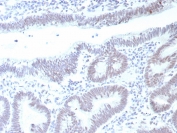 Immunohistochemistry analysis of TP53 / Tumor Protein 53 antibody in human colon carcinoma tissue (clone rTP53/8993). FFPE colon carcinoma sections demonstrate strong HRP-DAB brown nuclear staining in malignant epithelial cells lining glandular structures, consistent with nuclear accumulation of p53 protein in neoplastic cells. The staining pattern is predominantly nuclear with minimal cytoplasmic background and limited stromal signal. Adjacent non-neoplastic elements show weaker or absent staining by comparison. This nuclear localization aligns with the role of Tumor protein 53 as a transcription factor regulating cell cycle control and DNA damage responses. Heat induced epitope retrieval was performed by boiling tissue sections in pH 9 10mM Tris with 1mM EDTA for 20 minutes followed by cooling prior to primary antibody incubation.