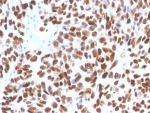 p53 Antibody / Stress Response Transcription Factor Antibody immunohistochemistry of human bladder tissue. Formalin-fixed, paraffin-embedded human bladder tissue was stained using recombinant rabbit monoclonal antibody clone TP53/3890R. Strong HRP-DAB brown nuclear staining is observed in urothelial epithelial cells, consistent with nuclear localization of the p53 stress response transcription factor. Hematoxylin counterstain provides nuclear contrast. Antigen retrieval was performed by boiling tissue sections in pH 9 10mM Tris with 1mM EDTA for 20 min followed by cooling prior to staining.