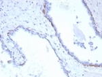 Cytokeratin 17 Antibody Recombinant Rabbit MAb KRT17/8320R immunohistochemistry analysis of human prostate carcinoma tissue. Immunohistochemistry of FFPE human prostate carcinoma demonstrates cytoplasmic brown chromogenic staining in epithelial tumor cells using the recombinant rabbit monoclonal Cytokeratin 17 antibody KRT17/8320R. The staining pattern highlights malignant epithelial cells consistent with the known expression profile of Cytokeratin 17 (CK17 / KRT17), an epithelial intermediate filament protein associated with basal-type epithelial differentiation and frequently evaluated in epithelial tumor studies. Heat-induced epitope retrieval was performed by boiling tissue sections in pH 9 10mM Tris with 1mM EDTA for 20 minutes followed by cooling prior to antibody incubation.