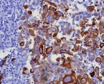 Keratin 17 Antibody Recombinant Rabbit MAb KRT17/8346R immunohistochemistry analysis of human lung adenocarcinoma tissue. Immunohistochemistry of FFPE human lung adenocarcinoma demonstrates cytoplasmic brown chromogenic staining in tumor epithelial cells using the recombinant rabbit monoclonal Keratin 17 antibody KRT17/8346R. The staining pattern highlights malignant epithelial cells consistent with the known expression of Cytokeratin 17 (CK17 / KRT17), an epithelial intermediate filament protein frequently detected in epithelial tumors and stratified epithelial tissues. Heat-induced epitope retrieval was performed by boiling tissue sections in pH 9 10mM Tris with 1mM EDTA for 20 minutes followed by cooling prior to antibody incubation.