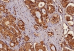 Pan Cytokeratin Antibody prostate carcinoma IHC. Immunohistochemistry analysis of cytokeratin expression in FFPE human prostate carcinoma tissue using Pan Cytokeratin antibody clone MonoPoly/4999R. Strong cytoplasmic HRP-DAB brown staining highlights malignant epithelial cells forming irregular glandular structures, clearly separating carcinoma cells from surrounding stromal components. The staining pattern supports identification of epithelial tumor origin and visualization of tumor morphology. HIER was performed by boiling tissue sections in pH 9 10 mM Tris with 1 mM EDTA for 20 minutes followed by cooling prior to antibody incubation.