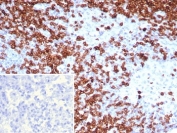 CD7 Antibody Human Lymph Node IHC. Immunohistochemistry analysis of CD7 / T-cell antigen CD7 in human lymph node tissue shows strong HRP-DAB brown membranous staining of lymphocytes within paracortical regions with relative sparing of germinal centers, consistent with CD7 expression on cytotoxic lymphocyte populations, while surrounding areas remain largely negative. The inset shows absence of staining when PBS is used in place of primary antibody, confirming specificity. CD7 antibody clone CD7/7605 was applied following heat-induced epitope retrieval in pH 9 Tris-EDTA buffer, supporting its use as a cytotoxic lymphocyte marker in FFPE tissue sections.