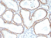 IHC staining of FFPE human renal cell carcinoma tissue with Basigin/CD147 antibody (clone BSG/7952) at 2ug/ml. HIER: boil tissue sections in pH 9 10mM Tris with 1mM EDTA for 20 min and allow to cool before testing.