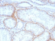 Immunohistochemistry analysis of HAb18G antibody in human renal cell carcinoma tissue (clone BSG/7957). FFPE human renal cell carcinoma sections demonstrate HRP-DAB brown membranous and cytoplasmic staining in tumor epithelial cells forming tubular and glandular structures. The staining highlights cell surface localization consistent with CD147 Basigin expression in neoplastic cells, with minimal background in surrounding stromal elements. Heat induced epitope retrieval was performed by boiling tissue sections in pH 9 10 mM Tris with 1 mM EDTA for 20 minutes followed by cooling prior to antibody incubation.