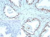 ERCC1 Antibody Prostate IHC. Immunohistochemistry staining of FFPE human prostate tissue with ERCC1 antibody (clone ERCC1/7596). Inset: PBS used in place of primary Ab (secondary Ab negative control). HIER: boil tissue sections in pH 9 10mM Tris with 1mM EDTA for 20 min and allow to cool before testing.