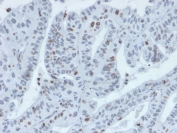 Interferon Regulatory Factor 3 Antibody Tumor IHC. Immunohistochemistry analysis of FFPE human tumor tissue stained with Interferon Regulatory Factor 3 Antibody demonstrates predominantly nuclear HRP-DAB brown staining within malignant epithelial cell populations, consistent with activated IRF3-associated antiviral signaling and interferon-regulatory transcriptional pathway activity. This antiviral response protein antibody highlights innate immune-associated transcriptional regulation and stress-response signaling within tumor tissue. HIER: boil tissue sections in pH 9 10mM Tris with 1mM EDTA for 20 min and allow to cool before testing.