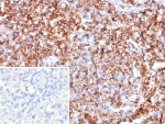Guanylate Binding Protein 1 Antibody Lymph Node IHC. Immunohistochemistry analysis of FFPE human lymph node tissue stained with Guanylate Binding Protein 1 Antibody clone GBP1/7617 demonstrates strong membranous and cytoplasmic HRP-DAB brown staining throughout dense lymphoid cellular populations, consistent with the role of Guanylate binding protein 1 / GBP1 in interferon-responsive immune activation and inflammatory signaling pathways. The widespread staining pattern aligns with the established function of GBP1 as an interferon-inducible GTPase associated with innate immune defense and cytokine-responsive cellular activation. The negative control inset using PBS in place of primary antibody demonstrates minimal background secondary antibody binding. HIER: boil tissue sections in pH 9 10mM Tris with 1mM EDTA for 20 min and allow to cool before testing.