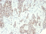 LSD1 Antibody Ovarian Carcinoma IHC. Immunohistochemistry analysis of FFPE human ovarian carcinoma tissue stained with LSD1 Antibody / Epigenetic Regulation Marker (clone PCRP-KDM1A-1A10). Tumor cells demonstrate prominent nuclear HRP-DAB brown staining consistent with the chromatin-associated localization expected for Lysine-specific demethylase 1 / KDM1A, an epigenetic regulator involved in transcriptional repression and histone demethylation pathways. Sections underwent HIER using 10mM Tris with 1mM EDTA buffer, pH 9, prior to antibody incubation and chromogenic detection.