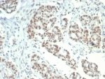 LSD1 Antibody Colon Carcinoma IHC. Immunohistochemistry analysis of FFPE human colon carcinoma tissue stained with LSD1 Antibody / Epigenetic Regulation Marker (clone PCRP-KDM1A-1A10). Strong nuclear HRP-DAB brown staining is observed in colon carcinoma cells, consistent with the expected nuclear localization of LSD1/KDM1A within chromatin remodeling and epigenetic transcriptional regulatory complexes. Tissue sections underwent HIER using 10mM Tris with 1mM EDTA buffer, pH 9, followed by staining with clone PCRP-KDM1A-1A10.