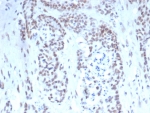 TARDBP Antibody Mouse Monoclonal Prostate IHC. Immunohistochemistry of TARDBP antibody in human prostate tissue. FFPE human prostate demonstrates predominantly nuclear HRP-DAB brown staining within glandular epithelial cells, consistent with the known nuclear localization of TAR DNA binding protein 43 / TDP-43 as an RNA-binding transcriptional regulator. Clone TARDP/349 was used as a mouse monoclonal antibody for detection. Heat-induced epitope retrieval was performed by boiling tissue sections in pH 9, 10 mM Tris with 1 mM EDTA for 20 minutes followed by cooling prior to staining.