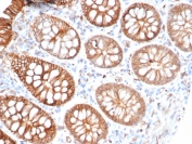S100A16 Antibody Glandular Tumor IHC. Immunohistochemistry of S100 calcium binding protein A16 / S100A16 in FFPE human colon carcinoma tissue using mouse monoclonal S100A16 antibody, clone S100A16/7411. HRP-DAB brown staining highlights cytoplasmic and membranous labeling of tumor epithelial cells forming glandular structures, consistent with epithelial differentiation, while surrounding stromal cells show minimal staining and nuclei are counterstained blue. Heat induced epitope retrieval was performed by boiling tissue sections in pH 9 10 mM Tris with 1 mM EDTA for 20 min followed by cooling prior to staining.