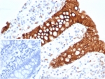 S100A16 Antibody Tumor Epithelium IHC. Immunohistochemistry of S100 calcium binding protein A16 / S100A16 in FFPE human colon carcinoma tissue using mouse monoclonal S100A16 antibody, clone S100A16/7412. HRP-DAB brown staining highlights strong cytoplasmic and membranous labeling of malignant epithelial cells forming glandular structures, with heterogeneous intensity consistent with tumor-associated proliferation and altered differentiation, while surrounding stromal elements show minimal staining and nuclei are counterstained blue. Inset: PBS was used in place of primary antibody as a negative control to confirm specificity of staining. Heat induced epitope retrieval was performed by boiling tissue sections in pH 9 10 mM Tris with 1 mM EDTA for 20 min followed by cooling prior to staining.
