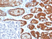 Immunohistochemistry of GLUL Antibody Recombinant Rabbit MAb GLUL/8256R in human brain tissue. Formalin-fixed, paraffin-embedded human brain sections demonstrate cytoplasmic HRP-DAB brown staining consistent with Glutamate-ammonia ligase (Glutamine synthetase) expression. Positive staining is observed within glial cell populations distributed throughout the neuropil, while neuronal nuclei remain unstained. The inset panel shows PBS used in place of primary antibody as a negative control with minimal background signal. Heat-induced epitope retrieval was performed by boiling tissue sections in pH 9 10 mM Tris with 1 mM EDTA for 20 min followed by cooling prior to antibody incubation.