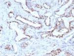 SLC45A3 Antibody for IHC. Immunohistochemistry analysis of Prostein / SLC45A3 antibody staining in FFPE human prostate tissue using clone SLC45A3/7653. Prominent cytoplasmic and perinuclear staining is observed in prostate glandular epithelial cells with a punctate distribution accentuating the Golgi region, consistent with the known Golgi-associated localization of Prostein, while adjacent stromal cells remain negative. The staining pattern highlights epithelial cell polarity and secretory compartment organization within prostate glands, with stronger signal along luminal epithelial layers. Heat-induced epitope retrieval was performed in pH 9 Tris-EDTA buffer for 20 minutes followed by cooling prior to antibody incubation.