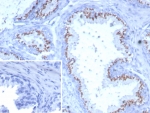 Solute carrier family 45 member 3 Antibody for IHC. Immunohistochemistry analysis of SLC45A3 / Prostein antibody staining in FFPE human prostate tissue using clone SLC45A3/7649. Distinct perinuclear and granular cytoplasmic staining is observed in prostate glandular epithelial cells outlining luminal borders, consistent with Golgi-associated localization of this solute carrier transport protein, while adjacent stromal components remain largely unstained. The inset negative control using PBS in place of primary antibody shows absence of signal, confirming specificity of the staining. Heat-induced epitope retrieval was performed in pH 9 Tris-EDTA buffer for 20 minutes followed by cooling prior to antibody incubation.