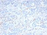 Immunohistochemistry analysis of Sal-like 4 Antibody in human kidney cancer tissue. Formalin-fixed, paraffin-embedded human kidney carcinoma stained with Sal-like 4 antibody (clone SALL4/7802R) demonstrates nuclear HRP-DAB brown staining in scattered tumor cells, consistent with the expected subcellular localization of SALL4 as a transcription factor. The staining pattern highlights discrete nuclei within the neoplastic cell population, while surrounding stromal elements show minimal background signal. Nuclear localization aligns with the known function of Sal-like protein 4 in regulating gene expression and maintaining stem cell-associated transcriptional programs. Heat-induced epitope retrieval was performed by boiling tissue sections in pH 9, 10mM Tris with 1mM EDTA for 20 minutes followed by cooling prior to immunostaining.