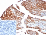 MX1 Antibody Ovarian Cancer IHC. Immunohistochemical staining of FFPE human ovarian cancer tissue using MX1 Antibody / Antiviral Response Protein Antibody (clone MX1/7527) demonstrates strong cytoplasmic and membranous HRP-DAB brown staining throughout malignant epithelial tumor cells. MX1 (Myxovirus Resistance Protein 1) is an interferon-inducible dynamin-like GTPase that functions as a key mediator of innate antiviral immunity and host defense. As a downstream effector of interferon signaling pathways, MX1 contributes to restriction of viral replication and serves as a widely utilized marker of interferon-responsive cellular activity. The observed staining pattern is consistent with expression of MX1 within neoplastic epithelial cells and supports the utility of this antibody for immunohistochemical detection of antiviral response proteins and interferon-regulated pathways in human tissues. Inset: PBS was used in place of the primary antibody as a negative control. HIER: boil tissue sections in pH 9, 10 mM Tris with 1 mM EDTA for 20 minutes and allow to cool before testing.