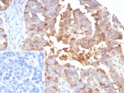Myxovirus Resistance Protein 1 Antibody Ovarian Cancer IHC. Immunohistochemical staining of FFPE human ovarian cancer tissue using Myxovirus Resistance Protein 1 Antibody / MX1 Antibody (clone MX1/7530) demonstrates moderate to strong granular cytoplasmic HRP-DAB brown staining within malignant epithelial tumor cells. MX1 is an interferon-inducible dynamin-like GTPase that functions as a key mediator of innate antiviral immunity and interferon-regulated host defense pathways. As a downstream effector of interferon signaling, MX1 contributes to cellular antiviral responses and is widely utilized as a marker of interferon pathway activation. The observed staining pattern is consistent with expression of MX1 within neoplastic epithelial cells and supports the utility of this antibody for immunohistochemical detection of interferon-responsive proteins in human tissues. Inset: PBS was used in place of the primary antibody as a negative control. HIER: boil tissue sections in pH 9, 10 mM Tris with 1 mM EDTA for 20 minutes and allow to cool before testing.