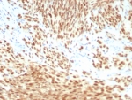 PRAME Antibody Melanoma IHC. Immunohistochemistry analysis of FFPE human melanoma tissue stained with recombinant rabbit monoclonal PRAME antibody clone PRAME/8558R. Tumor cells demonstrate strong nuclear HRP-DAB brown staining consistent with expression of Preferentially expressed antigen in melanoma / PRAME, a cancer-testis antigen involved in tumor-associated immune signaling and transcriptional regulation pathways. The observed staining pattern is consistent with established PRAME expression in melanoma-associated tumor cell populations. HIER: boil tissue sections in pH 9 10mM Tris with 1mM EDTA for 20 min and allow to cool before testing.