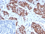 Immunohistochemistry analysis of MSH6 antibody in human ovarian cancer tissue. MSH6 Antibody Rabbit Monoclonal MSH6/8338R was used for immunohistochemistry on FFPE human ovarian carcinoma tissue. Strong HRP-DAB brown nuclear staining is observed in malignant epithelial cells, consistent with the nuclear localization of MutS homolog 6 (MSH6), a key DNA mismatch repair protein involved in recognition of replication errors. Tumor cell nuclei show prominent positive staining, while surrounding stromal elements display minimal signal. The inset panel shows the negative control in which PBS was used in place of the primary antibody, demonstrating absence of nuclear staining. Heat-induced epitope retrieval was performed by boiling tissue sections in pH 9 10mM Tris with 1mM EDTA for 20 min followed by cooling prior to immunostaining.