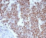 Immunohistochemistry analysis of MSH6 antibody in human small intestine tissue. MSH6 Antibody Recombinant Mouse MAb rMSH6/8181 was used for immunohistochemistry on FFPE human small intestine tissue. Strong HRP-DAB brown nuclear staining is observed in epithelial cells lining the intestinal glands and crypt regions, consistent with the nuclear localization of MutS homolog 6 (MSH6), a DNA mismatch repair protein involved in recognition of replication errors during DNA synthesis. The staining highlights proliferative epithelial cell populations within the mucosal compartment, while surrounding stromal and connective tissue elements show minimal signal. Heat-induced epitope retrieval was performed by boiling tissue sections in pH 9 10mM Tris with 1mM EDTA for 20 min followed by cooling prior to immunostaining.