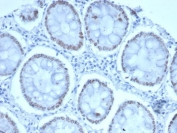 IHC staining of FFPE human colon tissue with SATB2 antibody (clone SATB2/7110). Strong nuclear staining is observed at 2ug/ml. HIER: boil tissue sections in pH 9 10mM Tris with 1mM EDTA for 20 min and allow to cool before testing.