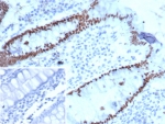 IHC staining of FFPE human colon carcinoma tissue with SATB2 antibody. Strong nuclear staining is observed using clone SATB2/7112 at 2ug/ml. Inset: PBS used in place of primary Ab (secondary Ab negative control). HIER: boil tissue sections in pH 9 10mM Tris with 1mM EDTA for 20 min and allow to cool before testing.