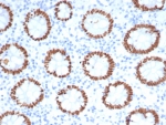 SATB2 Antibody Colon Tissue IHC. Immunohistochemistry staining of FFPE human colon tissue with SATB2 antibody. Strong nuclear staining is observed using clone SATB2/7112 at 2ug/ml. Inset: PBS used in place of primary Ab (secondary Ab negative control). HIER: boil tissue sections in pH 9 10mM Tris with 1mM EDTA for 20 min and allow to cool before testing.