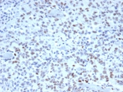MutS homolog 2 Antibody (clone MSH2/3165) / MSH2 Antibody. Immunohistochemistry analysis of FFPE human colon tissue from a Lynch syndrome patient using MutS homolog 2 antibody (clone MSH2/3165). Nuclear brown chromogenic staining identifies MutS homolog 2 / MSH2-positive cells within the tissue, while surrounding stromal and inflammatory cells serve as internal reference staining. Heat-induced epitope retrieval was performed by boiling tissue sections in pH 9 10mM Tris with 1mM EDTA for 20 minutes followed by cooling prior to staining.