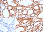 Paired box protein Pax-8 Antibody / PAX8 Antibody immunohistochemistry in human thyroid tissue showing strong nuclear HRP-DAB brown staining in follicular epithelial cells. Paired box protein Pax-8 (PAX8) expression is localized to nuclei lining thyroid follicles, with uniform nuclear positivity surrounding colloid-filled lumina and clear preservation of follicular architecture. The staining is confined to epithelial cell nuclei with minimal signal in stromal compartments, while colloid remains unstained. The nuclear pattern is consistent with transcription factor localization and highlights active epithelial lineage cells. Inset: negative control using PBS in place of primary antibody shows absence of specific staining. Heat-induced epitope retrieval was performed by boiling tissue sections in pH 9 10mM Tris with 1mM EDTA for 20 minutes followed by cooling prior to antibody incubation.