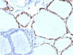 PAX8 Antibody / Negative Lineage Marker Contrast Antibody immunohistochemistry in human thyroid tissue showing strong nuclear HRP-DAB brown staining in follicular epithelial cells. Paired box protein Pax-8 (PAX8) expression is localized to nuclei lining thyroid follicles, with clear staining of epithelial cells surrounding colloid-filled lumina and minimal signal in stromal compartments. The robust nuclear positivity in this lineage-positive tissue provides a reference pattern that contrasts with the absence of staining observed in non-PAX8-expressing tumors, supporting the use of PAX8 as a negative lineage marker in exclusion-based analysis. Negative cells retain hematoxylin-only nuclear staining for clear interpretive contrast. HIER: boil tissue sections in pH 9 10mM Tris with 1mM EDTA for 20 min and allow to cool before testing.