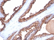 CD26 Antibody Prostate Cancer IHC. Immunohistochemistry analysis of FFPE human prostate cancer tissue stained with a mouse monoclonal CD26 antibody detecting Dipeptidyl peptidase 4 (DPP4). The antibody clone DPP4/7415 shows prominent membranous and cytoplasmic staining in tumor epithelial cells, consistent with the surface-associated enzyme activity of CD26 and its role as a T cell activation antigen within the tumor microenvironment. Additional staining in stromal regions supports the involvement of DPP4 in epithelial-stromal and immune cell interactions. Hematoxylin counterstain highlights nuclei in blue. HIER: boil tissue sections in pH 9 10 mM Tris with 1 mM EDTA for 20 min and allow to cool before testing.