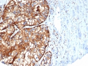 CD26 Antibody Kidney Cancer IHC. Immunohistochemistry analysis of FFPE human kidney cancer tissue stained with a mouse monoclonal CD26 antibody recognizing Dipeptidyl peptidase 4 (DPP4). The antibody clone DPP4/7415 demonstrates strong membranous and cytoplasmic staining in tumor epithelial cells, highlighting CD26 as a membrane-associated enzymatic marker with known roles in peptide processing and immune-related signaling. The staining pattern supports the utility of this antibody for studying DPP4 expression in tumor cells and its relevance to T cell activation pathways within the tumor microenvironment. Hematoxylin counterstain highlights nuclei in blue. HIER: boil tissue sections in pH 9 10 mM Tris with 1 mM EDTA for 20 min and allow to cool before testing.